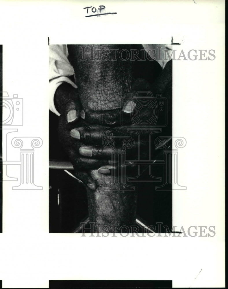 1991 Press Photo Harry Weeks holds his legs that show a condition that wont heal- Historic Images