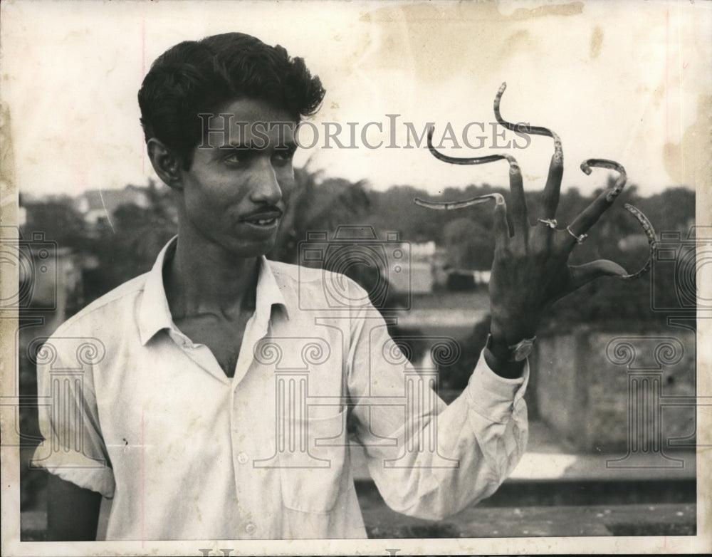 1969 Press Photo Murari Aditya holds up his left hand bearing what- Historic Images