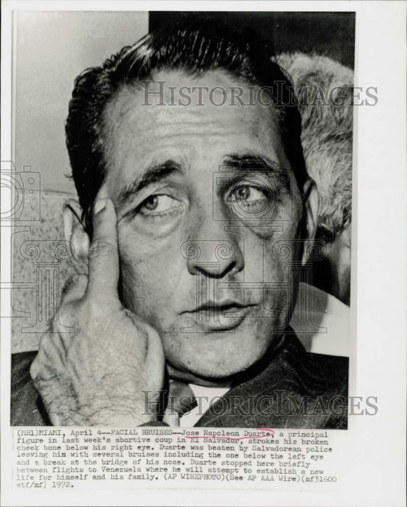 1972 Press Photo Jose Duarte shows his injuries from a beating in El Salvador- Historic Images