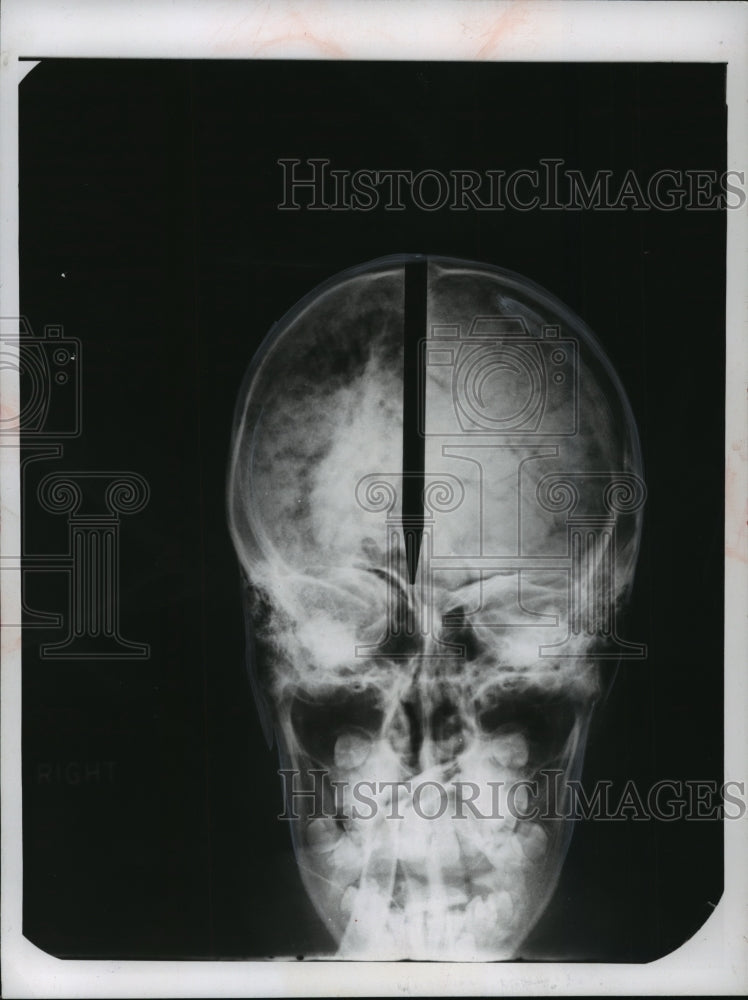 1956 Press Photo The half of the brain to the left of the pointer was removed- Historic Images