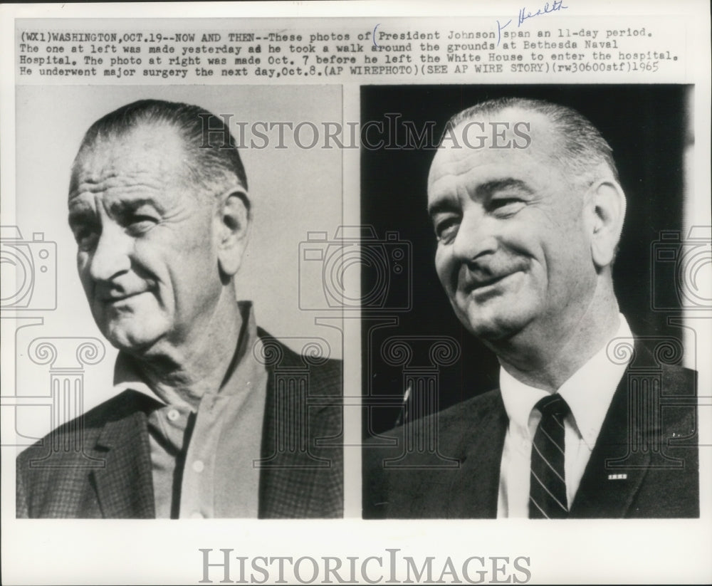 1965 Press Photo Photos of President Johnson pre/post surgery at Bethesda, MD- Historic Images