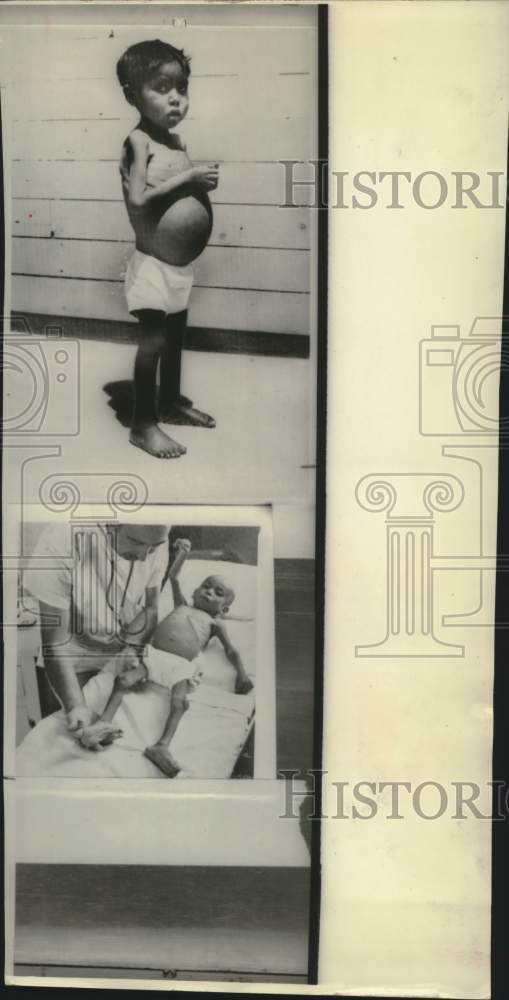 1966 Press Photo Tarahumara Indian Child in State of Starvation, Mexico