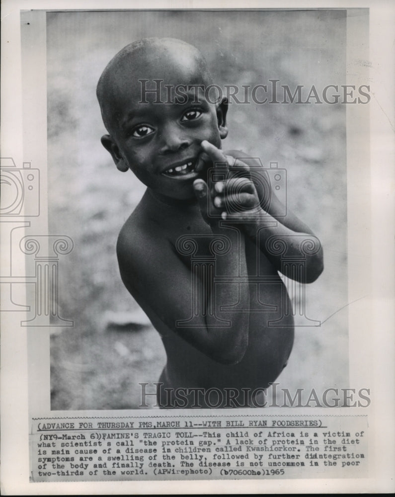 1965 Press Photo Child of Africa, Victim of Kwashiorkor Disease, Lack of Protein