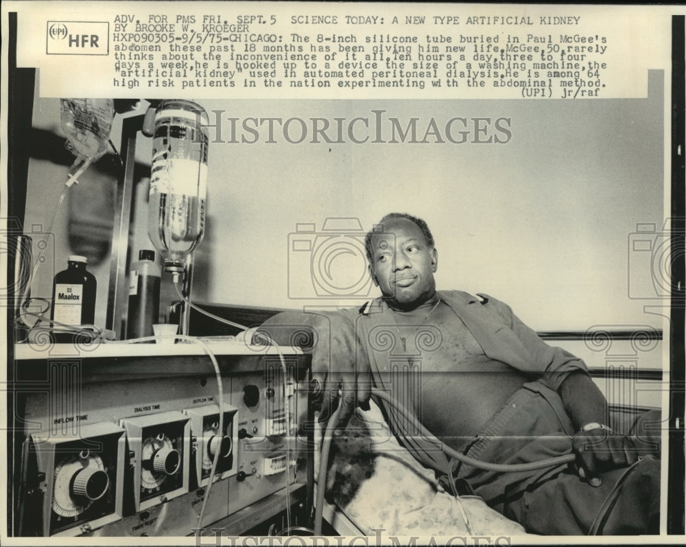 1975 Press Photo Paul McGee undergoes abdominal dialysis. There are 64 in trials- Historic Images