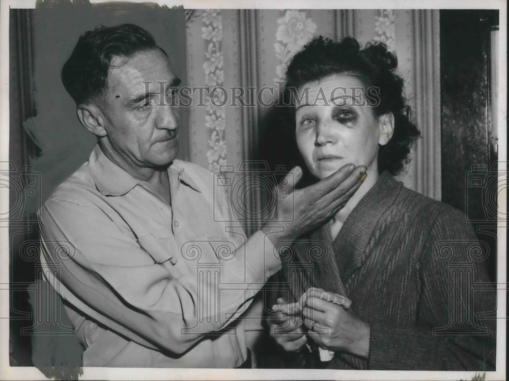 1955 Press Photo Thomas and Helen Todlack with black eyes