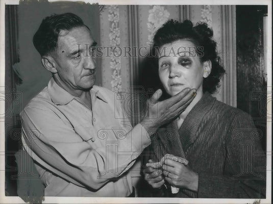 1955 Press Photo Thomas and Helen Todlack with black eyes
