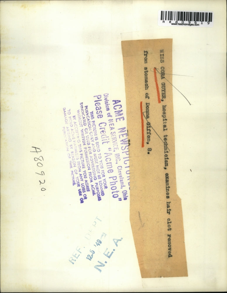 1949 Media Photo Woman Observing Hair Clot from Patient's Stomach