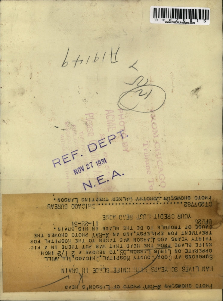 1931 Press Photo Linus Larson Gets 30 Year Old Knife Removed From His Head