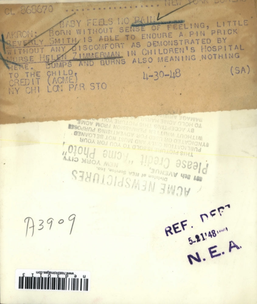 1948 Press Photo Beverly Smith Born Without Sense of Feeling