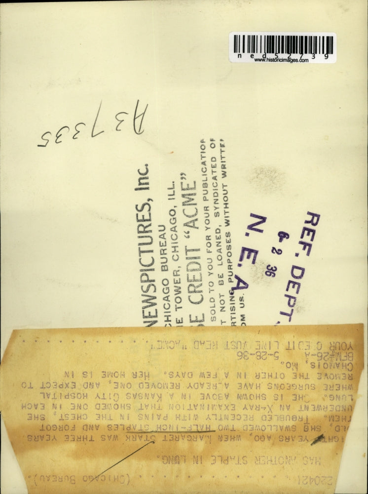 1936 Press Photo Margaret Stark in Hospital With Staples in Lungs