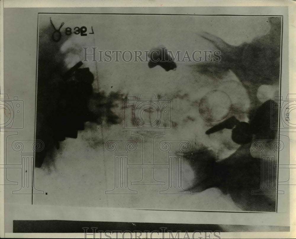 1928 Press Photo An accumulation of metal particles in soldier with dementia