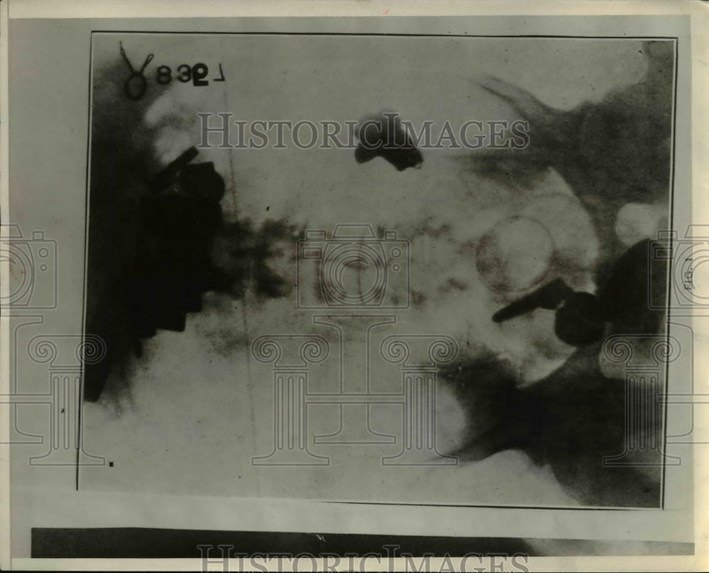 Load image into Gallery viewer, 1928 Press Photo An accumulation of metal particles in soldier with dementia
