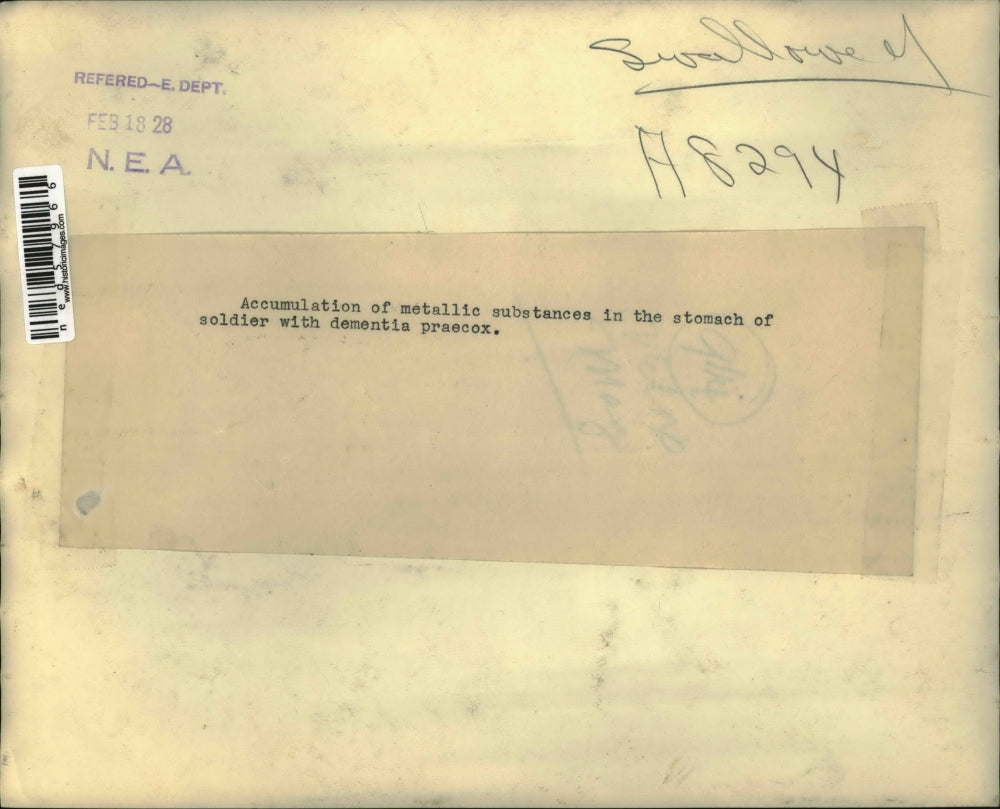 1928 Press Photo An accumulation of metal particles in soldier with dementia