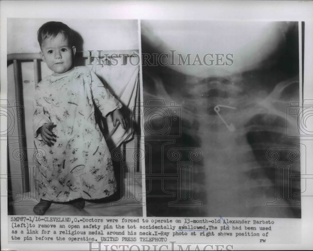 1954 Press Photo Cleveland Doctors were forced to operate on 13 month old