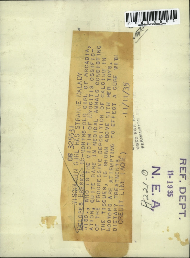 1935 Press Photo Dolores Breska, victim of myocitis ossification