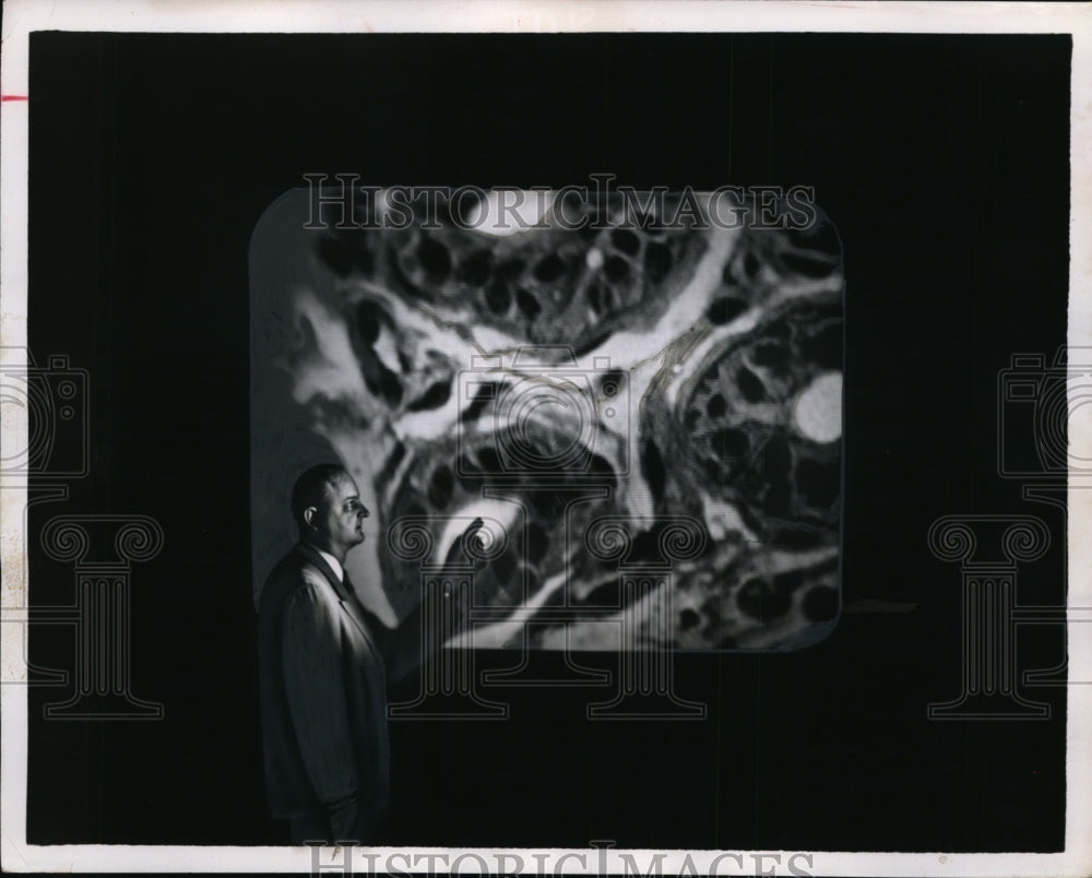 1955 Press Photo Cancer Cells Magnified 15,000x at CBS Laboratories - nef50316