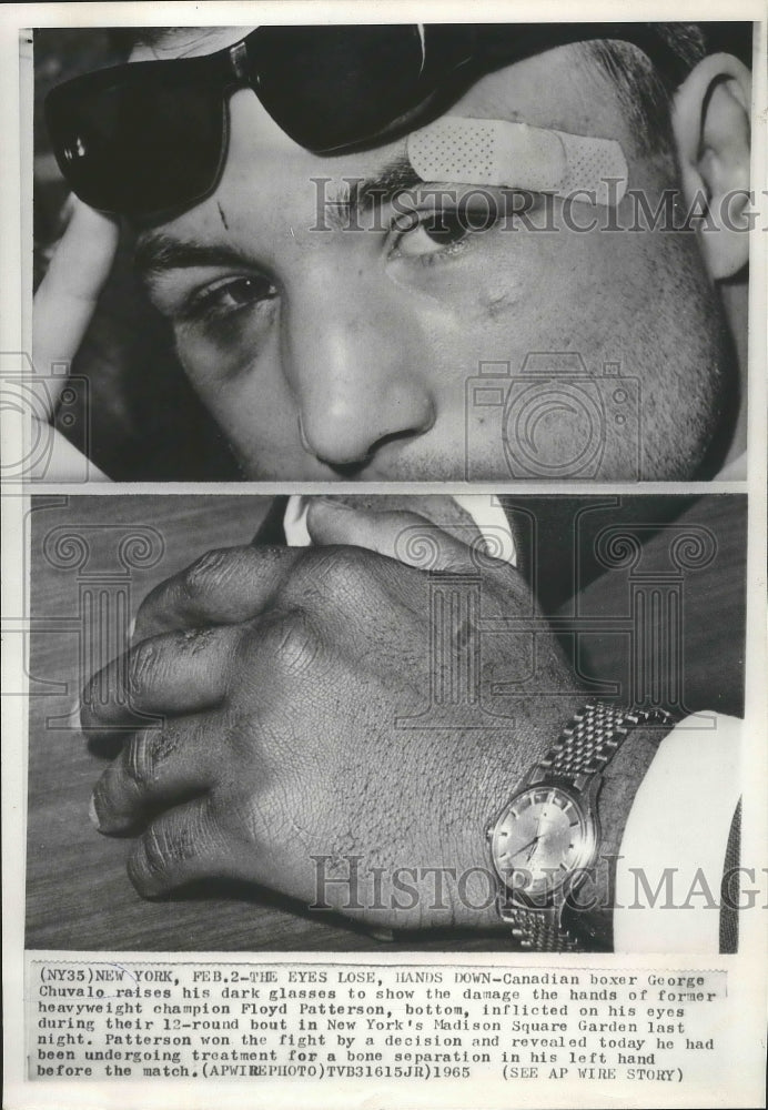 1935 Press Photo George Chvalo Canadian Boxer shows his damage Eyes - nef64459