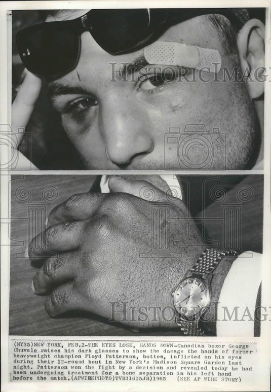 1935 Press Photo George Chvalo Canadian Boxer shows his damage Eyes - nef64459
