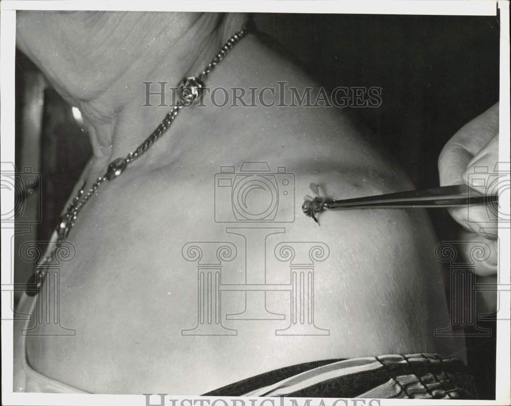 1940 Press Photo A woman undergoes bee sting therapy for arthritis - nei19303- Historic Images