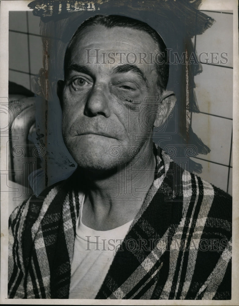 1955 Press Photo Bernard Hamilton with Bruised eye - neo00443