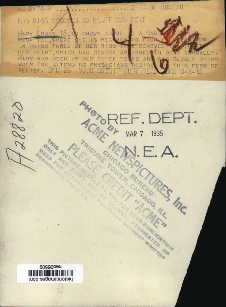 1935 Press Photo Mary Erwin, Ribs Removed so Heart Could Beat, Kansas City