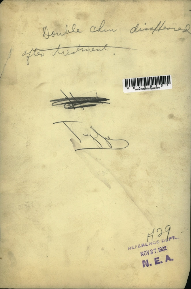 1922 Press Photo A woman with a double chin that was fixed by surgery