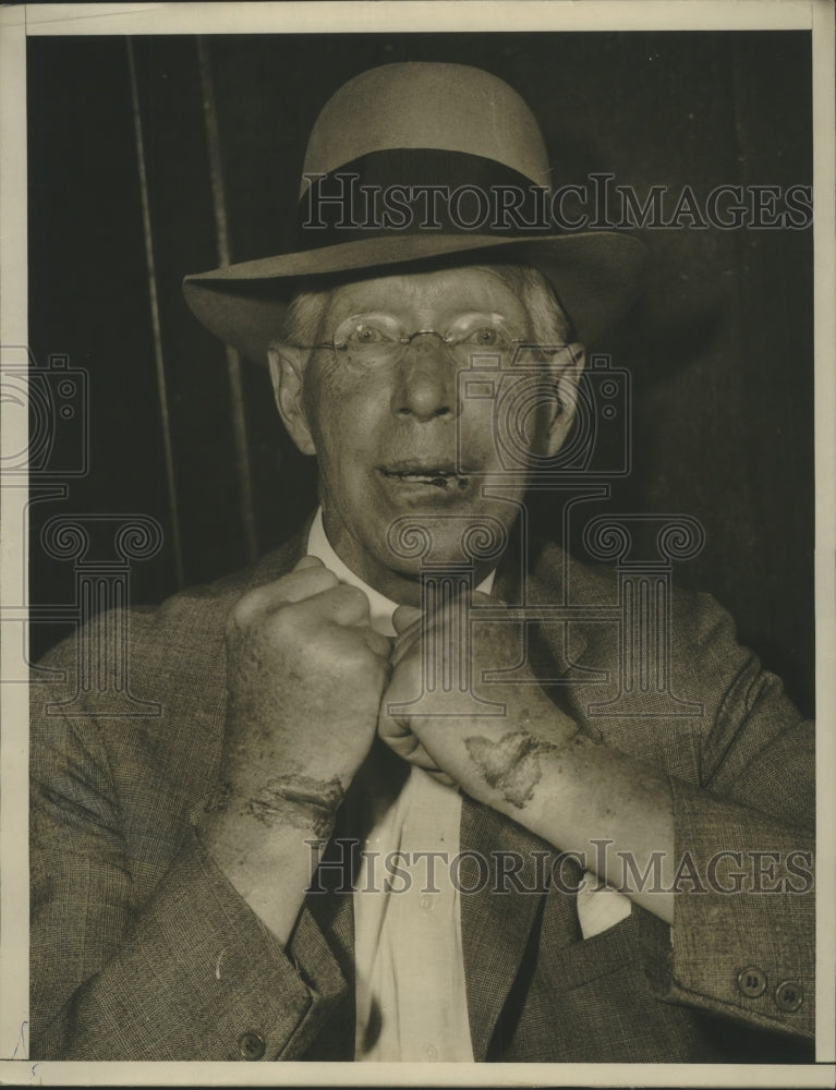 1953 Press Photo William F. Wood, Kidnapping Victim Displaying Wrist Scars