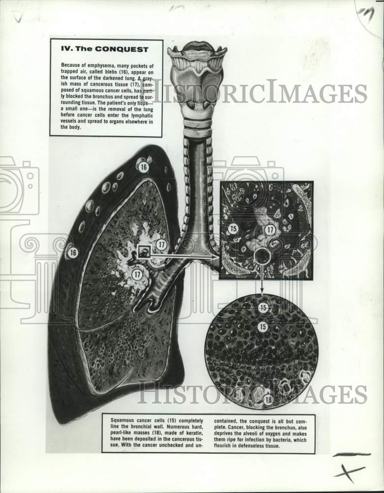 1966 Press Photo Medical Illustration of the lung infected with emphysema- Historic Images