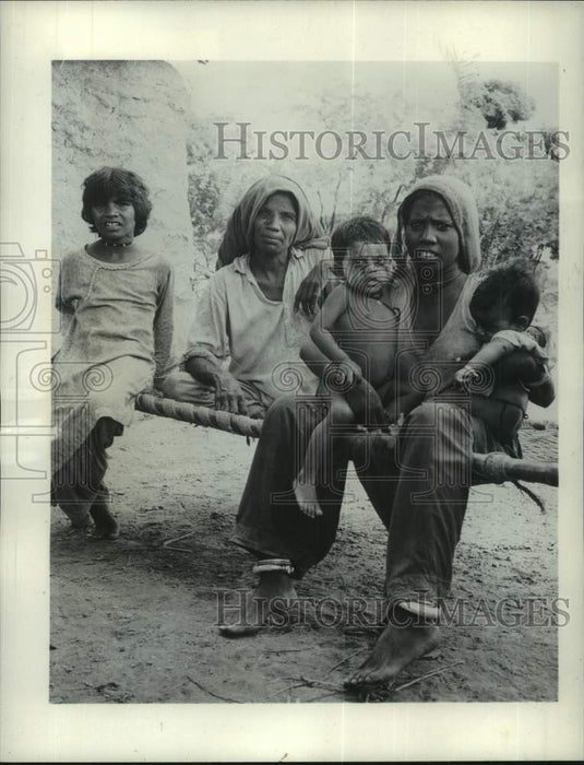 1963 Press Photo Malnourished children in India shows bloated stomach