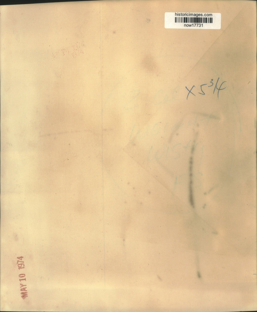 1974 Press Photo Debi Horn had jaws wired shut to lose weight - now17731