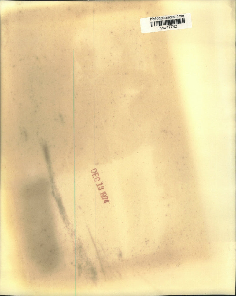 1974 Press Photo Debi Horn, first American to have jaws wired to lose weight