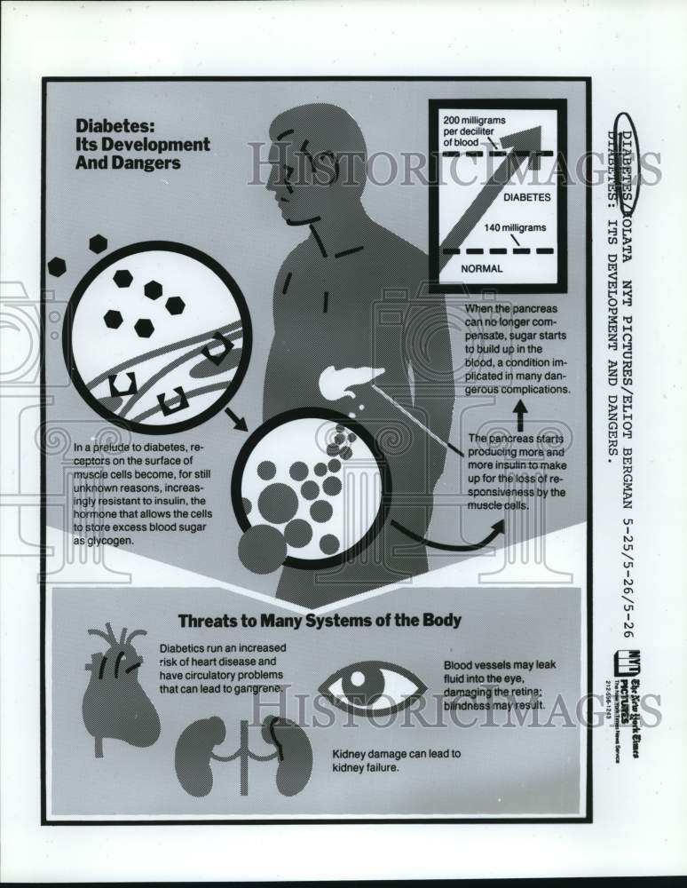 Press Photo Diabetes: Its Development and Dangers poster - saa68081- Historic Images