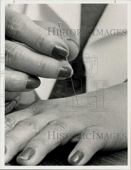 1984 Press Photo Woman administers Acupuncture Needle - sra09546- Historic Images