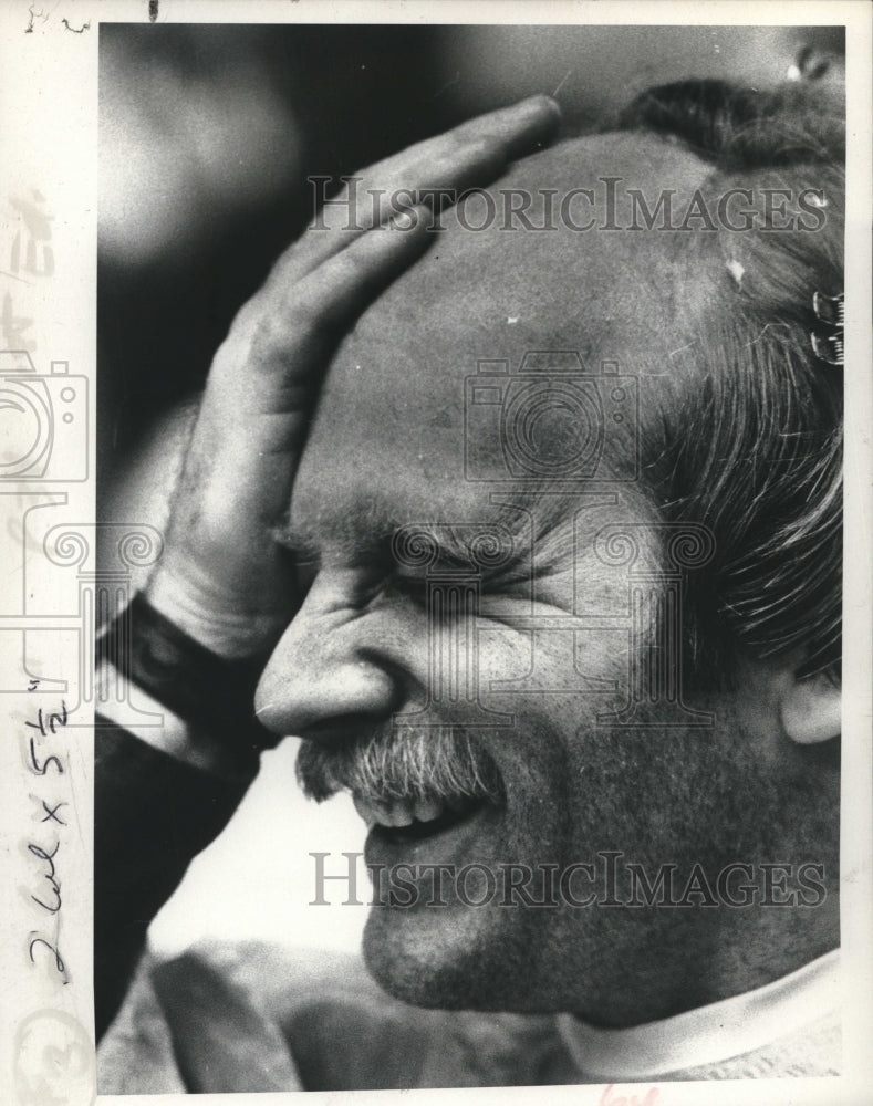 1975 Press Photo Actor Andy Wyman lost hair for a theater performance- Historic Images