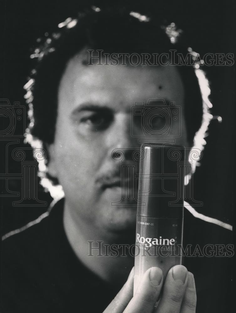 1989 Press Photo Jeff Kuber Tried Rogaine, Anti-Baldness Product - mjb38511 - Historic Images