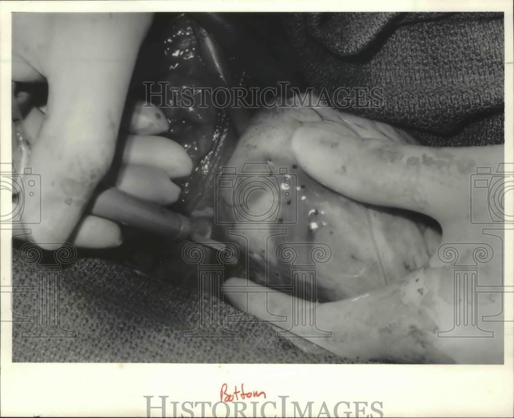 1985 Press Photo Mahmood Mirhoseini used laser to put channels in a human heart. - Historic Images