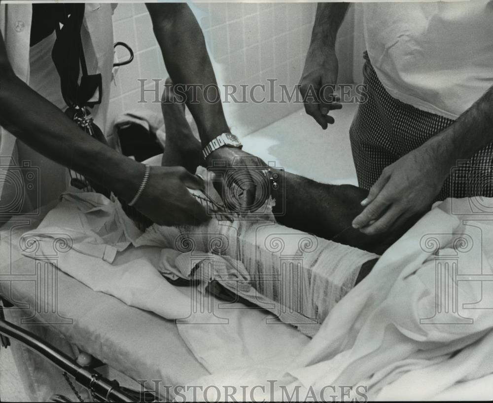 1977 Press Photo Doctors Remove Splint at Cooper Green Hospital, Birmingham, AL - Historic Images