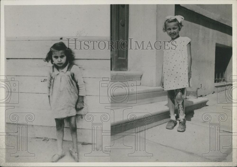 Press Photo Child Before And After Treatmnt Crippled Child Center In Athens - Historic Images