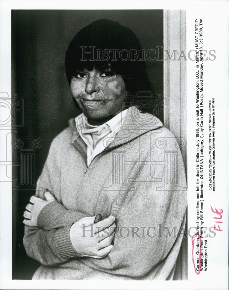 1986 Press Photo Carmen Quintana, burned by soldiers, left for dead in Chile - Historic Images