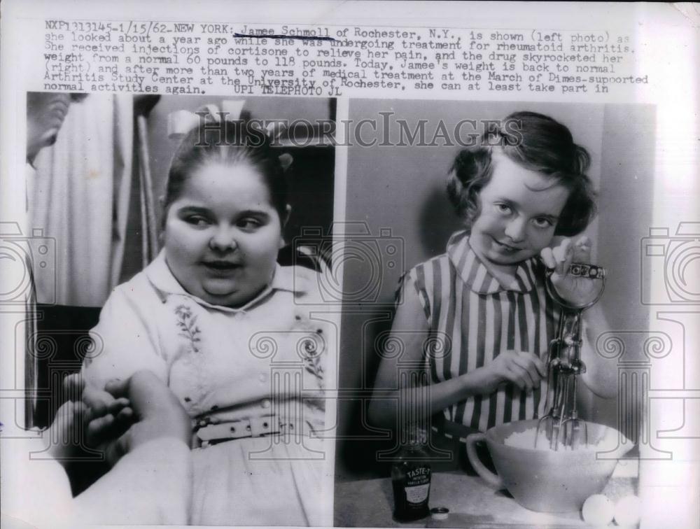 1962 Press Photo Jamee Schmoll Rochester NY Rheumatoid Arthritis Treatment - Historic Images
