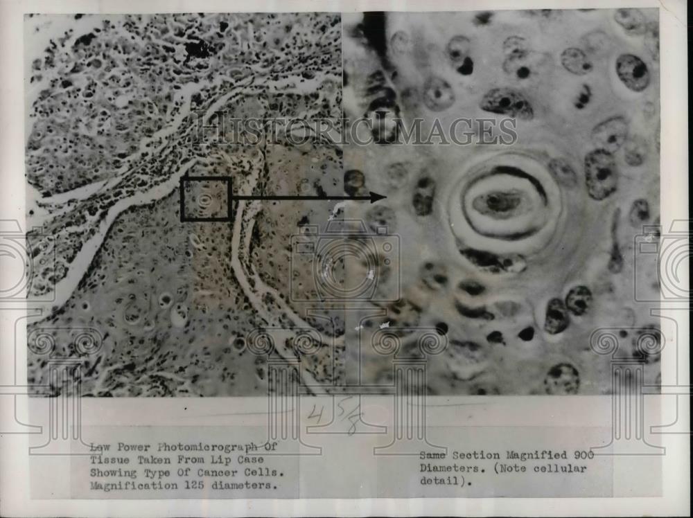 1938 Press Photo Cancer Cells - nea32510 - Historic Images