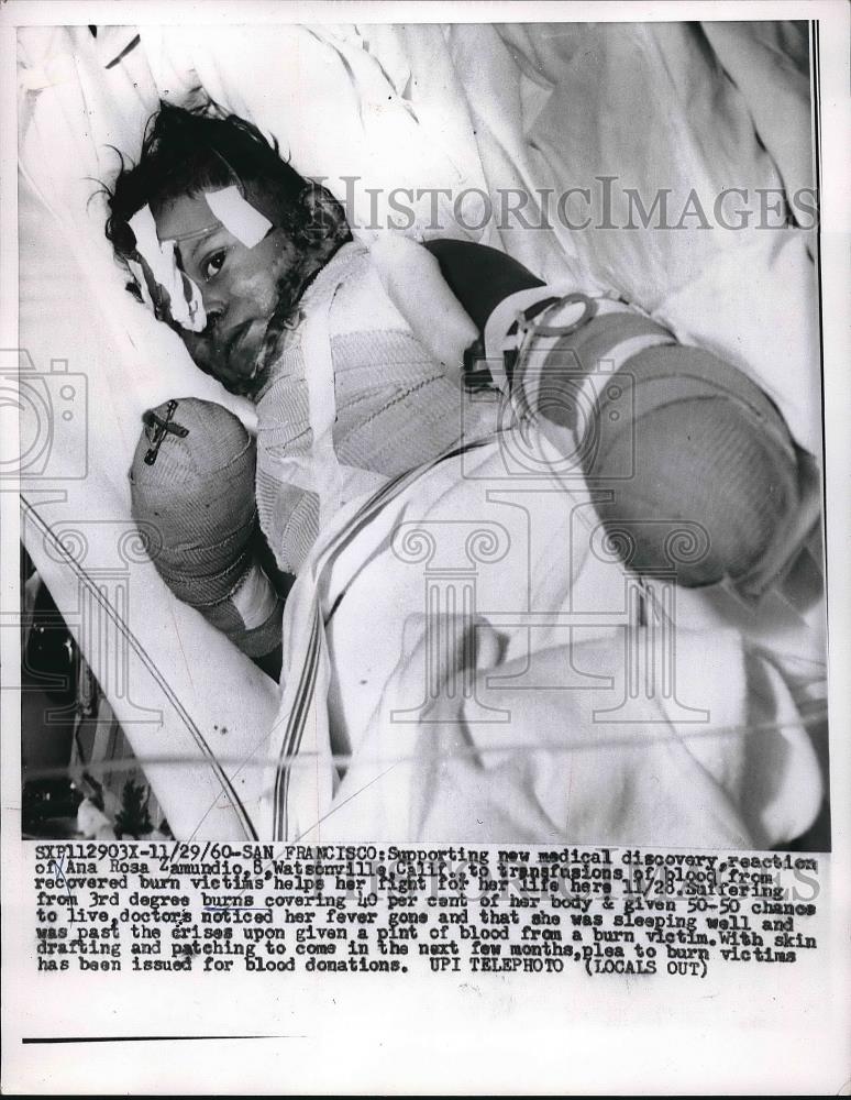 1960 Press Photo Ana Rosa Zamundio in Hospital with Severe Burns - Historic Images