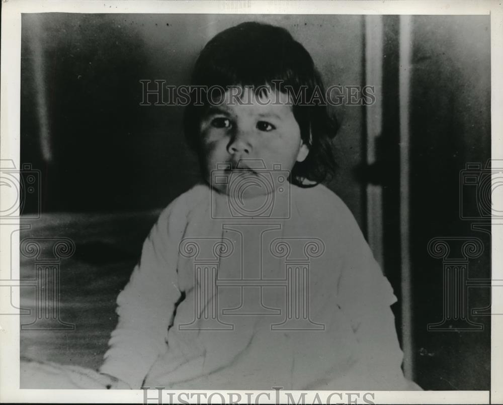 1942 Press Photo Indian childthat was treated with sulfa drugs for eye problem - Historic Images