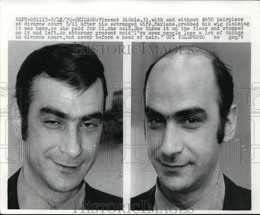 1970 Media Photo Vincent Dicola Before and After Hairpiece - Historic Images
