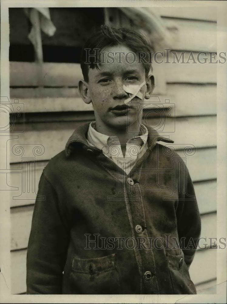 1930 Press Photo Stewart Carneal child wounded by bomb explosion - Historic Images