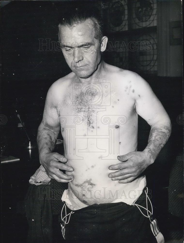 1953 Press Photo Friedrich Jadicke ,had been tortured by acid - Historic Images