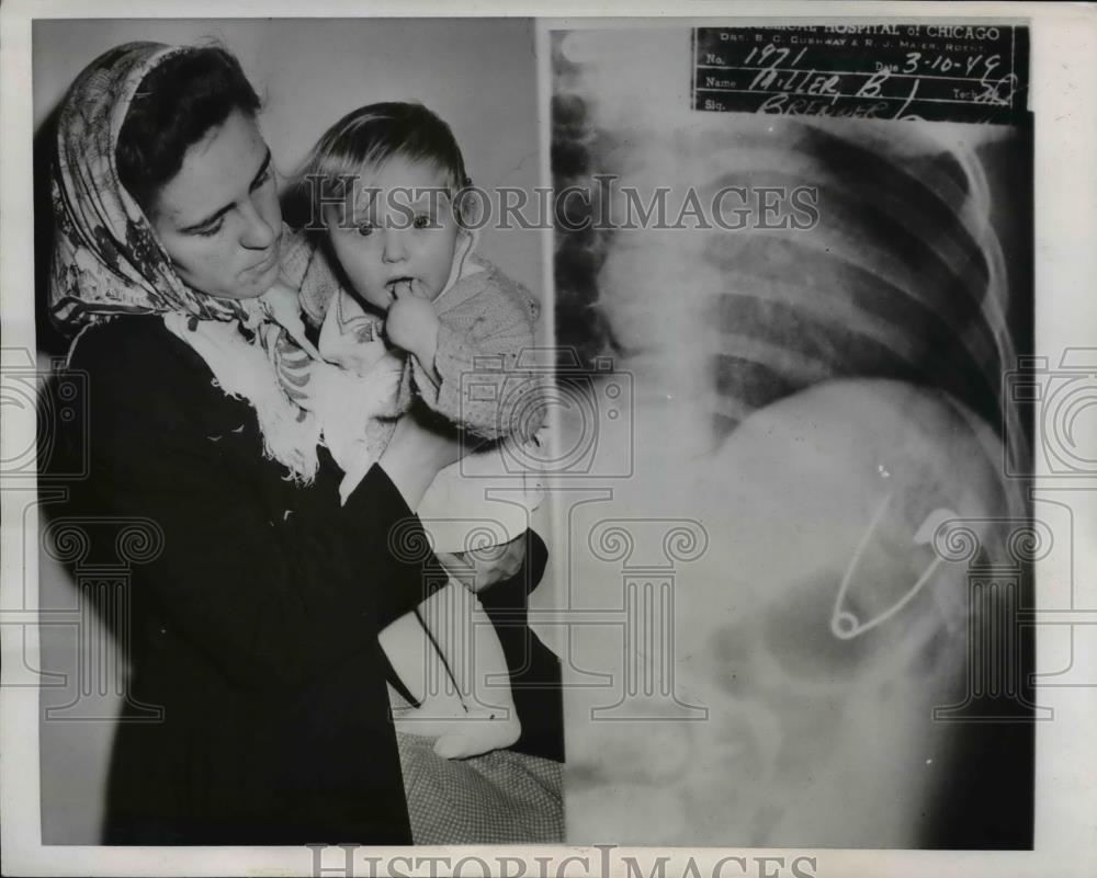 1949 Press Photo Child Swallowed Safety Pin - Historic Images