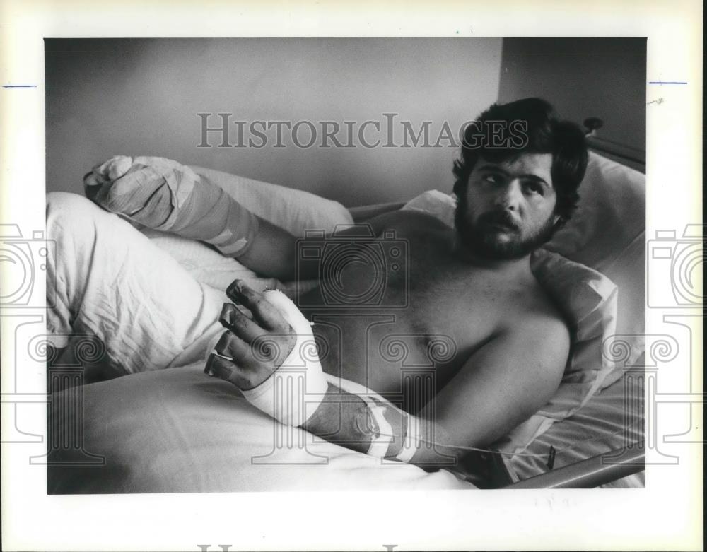 1981 Press Photo Billy R. Dees lost his nine fingers in a Shearing machine. - Historic Images