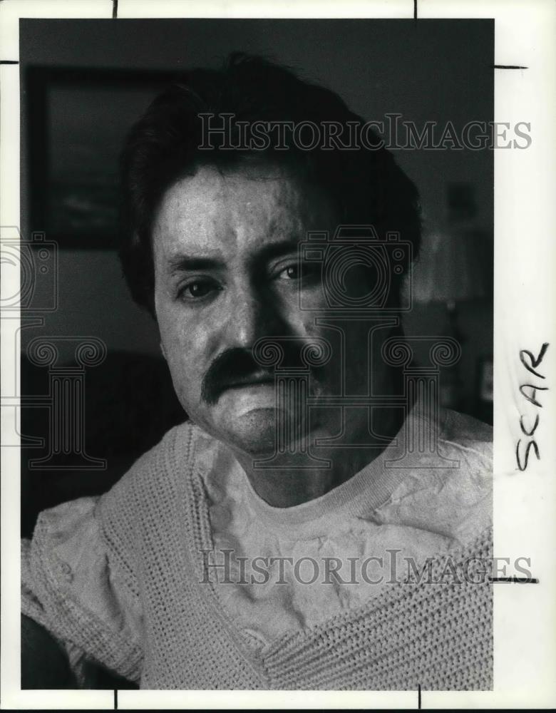 1990 Press Photo James Lawson Talks of Recovery After Face &amp; Body Burned - Historic Images