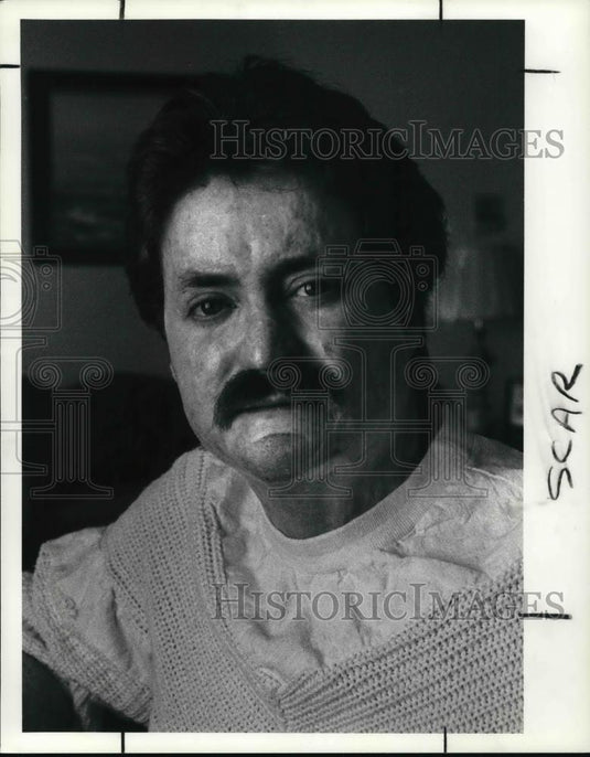1990 Press Photo James Lawson Talks of Recovery After Face & Body Burned - Historic Images